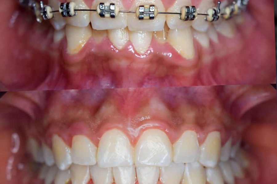 dental implants a